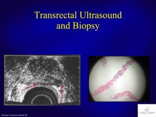Transrectal Ultrasound and Biopsy 
