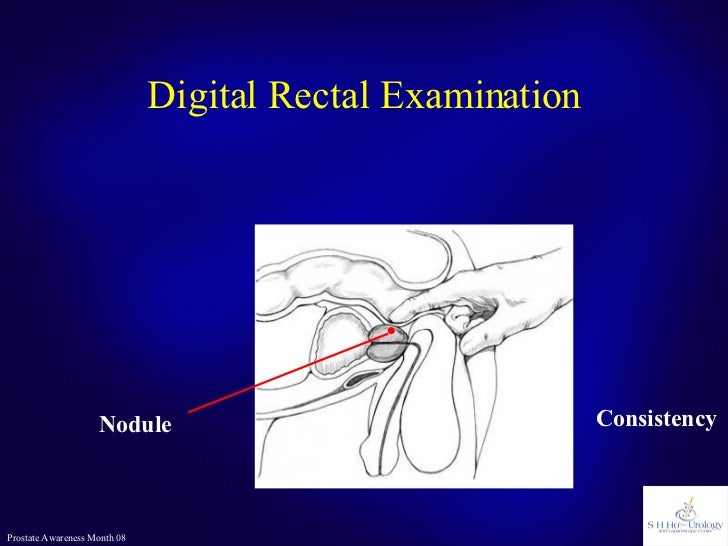 Prostate Cancer or Not