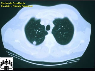Paciente Centro de Excelência Einstein  –  Nódulo Pulmonar  