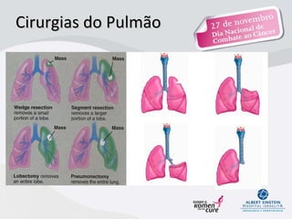 Cirurgias do Pulmão   