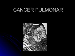 CANCER PULMONAR 
