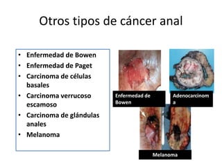 Otros tipos de cáncer anal
• Enfermedad de Bowen
• Enfermedad de Paget
• Carcinoma de células
basales
• Carcinoma verrucoso
escamoso
• Carcinoma de glándulas
anales
• Melanoma
Enfermedad de
Bowen
Adenocarcinom
a
Melanoma
 