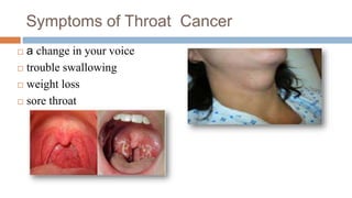 Symptoms of Throat Cancer
 a change in your voice
 trouble swallowing
 weight loss
 sore throat
 
