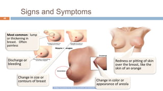 Signs and Symptoms
48
Most common: lump
or thickening in
breast. Often
painless
Change in color or
appearance of areola
Redness or pitting of skin
over the breast, like the
skin of an orange
Discharge or
bleeding
Change in size or
contours of breast
 