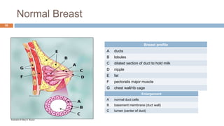 Normal Breast
50
Breast profile
A ducts
B lobules
C dilated section of duct to hold milk
D nipple
E fat
F pectoralis major muscle
G chest wall/rib cage
Enlargement
A normal duct cells
B basement membrane (duct wall)
C lumen (center of duct)
Illustration © Mary K. Bryson
 