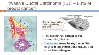 Invasive Ductal Carcinoma (IDC – 80% of
breast cancer)52
 The cancer has spread to the
surrounding tissues
 Carcinoma refers to any cancer that
begins in the skin or other tissues that
cover internal organs
Illustration © Mary K. Bryson
Ductal cancer cells
breaking through
the wall
 