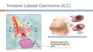 Invasive Lobular Carcinoma (ILC)
53
Illustration © Mary K. Bryson
Lobular cancer cells
breaking through the
wall
 