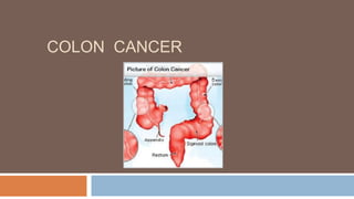 COLON CANCER
 