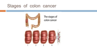 Stages of colon cancer
 