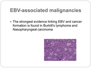 EBV-associated malignancies
 The strongest evidence linking EBV and cancer
formation is found in Burkitt's lymphoma and
Nasopharyngeal carcinoma
 