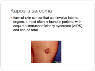 Kaposi's sarcoma
 form of skin cancer that can involve internal
organs. It most often is found in patients with
acquired immunodeficiency syndrome (AIDS),
and can be fatal.
 