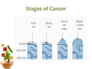 Stages of Cancer
 