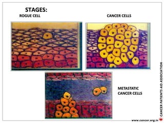 STAGES:
ROGUE CELL CANCER CELLS
METASTATIC
CANCER CELLS
 