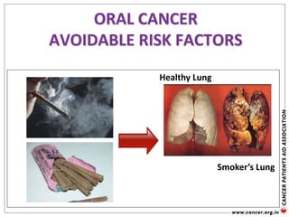 Healthy Lung
Smoker’s Lung
ORAL CANCER
AVOIDABLE RISK FACTORS
 