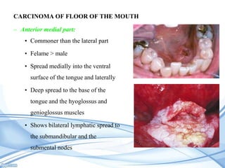 CARCINOMA OF PALATE

• Disease of the elderly (60 – 70 years)
• Associated with reverse smoking
• Common location for carc...