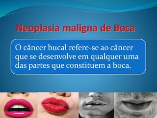 O câncer bucal refere-se ao câncer 
que se desenvolve em qualquer uma 
das partes que constituem a boca. 
 
