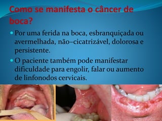 Como se manifesta o câncer de 
boca? 
 Por uma ferida na boca, esbranquiçada ou 
avermelhada, não–cicatrizável, dolorosa e 
persistente. 
 O paciente também pode manifestar 
dificuldade para engolir, falar ou aumento 
de linfonodos cervicais. 
 