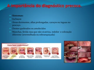 A importância do diagnóstico precoce. 
 Sintomas: 
 Inchaços 
 Áreas dormentes, aftas prolongadas, caroços ou ínguas no 
pescoço. 
 Dentes quebrados ou amolecidos 
 Manchas, ferida rasa que não cicatriza, indolor e coloração 
diferente (avermelhada ou esbranquiçada) 
 