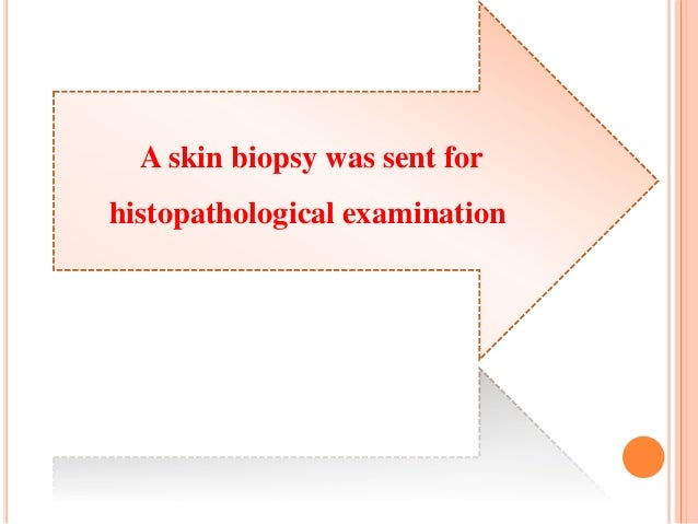 cutaneous metastasis of breast cancer