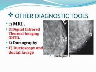 Dactography Types manegmentof cancer breast during pregnancy.pptx
