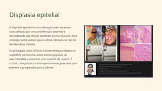 Displasia epitelial
A displasia epitelial é uma alteração pré-cancerosa
caracterizada por uma proliferação anormal e
desordenada das células epiteliais da mucosa oral. Essa
condição pode evoluir para o câncer de boca se não for
devidamente tratada.
Os principais sinais clínicos incluem irregularidades na
superfície da mucosa, áreas esbranquiçadas ou
avermelhadas e manchas com aspecto de nuvem. É
crucial o diagnóstico e acompanhamento precoces para
prevenir a progressão para o câncer.
 