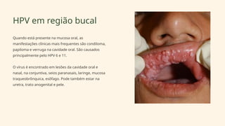 HPV em região bucal
Quando está presente na mucosa oral, as
manifestações clínicas mais frequentes são condiloma,
papiloma e verruga na cavidade oral. São causados
principalmente pelo HPV 6 e 11.
O vírus é encontrado em lesões da cavidade oral e
nasal, na conjuntiva, seios paranasais, laringe, mucosa
traqueobrônquica, esôfago. Pode também estar na
uretra, trato anogenital e pele.
 