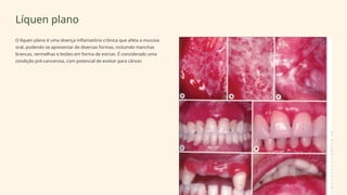 Líquen plano
O líquen plano é uma doença inflamatória crônica que afeta a mucosa
oral, podendo se apresentar de diversas formas, incluindo manchas
brancas, vermelhas e lesões em forma de estrias. É considerado uma
condição pré-cancerosa, com potencial de evoluir para câncer.
 