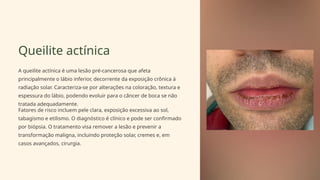 Queilite actínica
A queilite actínica é uma lesão pré-cancerosa que afeta
principalmente o lábio inferior, decorrente da exposição crônica à
radiação solar. Caracteriza-se por alterações na coloração, textura e
espessura do lábio, podendo evoluir para o câncer de boca se não
tratada adequadamente.
Fatores de risco incluem pele clara, exposição excessiva ao sol,
tabagismo e etilismo. O diagnóstico é clínico e pode ser confirmado
por biópsia. O tratamento visa remover a lesão e prevenir a
transformação maligna, incluindo proteção solar, cremes e, em
casos avançados, cirurgia.
 