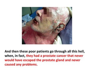 If we didn’t go through all this aggressive diagnosis of
cancer, we would never have known these cancers
existed, and the cancer rate would be much lower. By
over-diagnosing, they improve their statistics. It makes
it look like the war on cancer has made headway, when
in truth they haven’t made any headway.
 