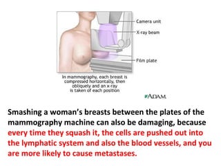 A woman who has annual mammograms for ten years
has a 50% chance of having at least one biopsy, even if
she never develops breast cancer.
 