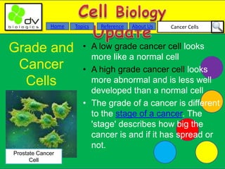 Cancer CellsAbout UsTopicsHome Reference
Grade and
Cancer
Cells
• A low grade cancer cell looks
more like a normal cell
• A high grade cancer cell looks
more abnormal and is less well
developed than a normal cell
• The grade of a cancer is different
to the stage of a cancer. The
'stage' describes how big the
cancer is and if it has spread or
not.
Prostate Cancer
Cell
 