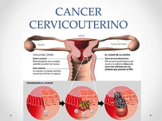 CANCER
CERVICOUTERINO
 