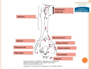 Metástasis
distantes
Aórticos
Sacros
Paracervical
Obturador
Iliacos comun
Iliaca interna
Iliaca externa
Parametrio
Inguinal
 