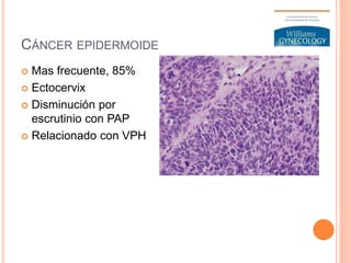 CÁNCER EPIDERMOIDE
 Mas frecuente, 85%
 Ectocervix
 Disminución por
escrutinio con PAP
 Relacionado con VPH
 