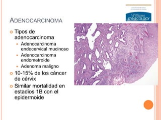 ADENOCARCINOMA
 Tipos de
adenocarcinoma
 Adenocarcinoma
endocervical mucinoso
 Adenocarcinoma
endometroide
 Adenoma maligno
 10-15% de los cáncer
de cérvix
 Similar mortalidad en
estadios 1B con el
epidermoide
 