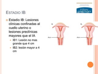 ESTADIO IB
 Estadio IB: Lesiones
clínicas confinadas al
cuello uterino o
lesiones preclínicas
mayores que el IA
 IB1: Lesión no mas
grande que 4 cm
 IB2: lesión mayor a 4
cm
 
