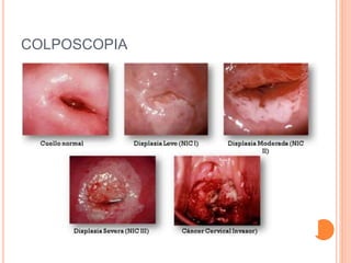 COLPOSCOPIA
 