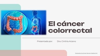 Illustration by Smart-Servier Medical Art
El cáncer
colorrectal
Presentado por: Dra. Cinthia Arzeno
 