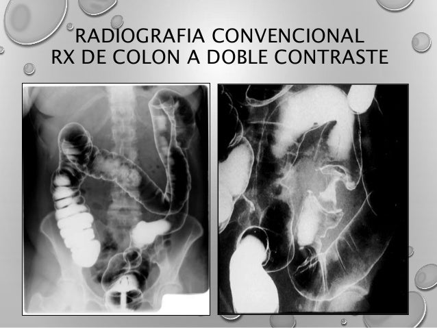 Colon En Rx CANCER COLORECTAL Prevención, Diagnóstico y Tratamiento