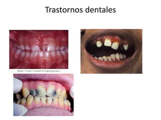 Trastornos dentales
 