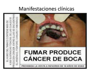 Manifestaciones clínicas
 