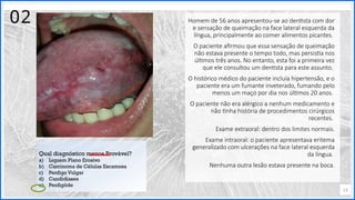 Contoso
P a c o t e s
Opção 2 de Divisor
de Seção
Lorem ipsum dolor sit ame
adipiscing elit
13
02 Homem de 56 anos apresentou-se ao dentista com dor
e sensação de queimação na face lateral esquerda da
língua, principalmente ao comer alimentos picantes.
O paciente afirmou que essa sensação de queimação
não estava presente o tempo todo, mas persistia nos
últimos três anos. No entanto, esta foi a primeira vez
que ele consultou um dentista para este assunto.
O histórico médico do paciente incluía hipertensão, e o
paciente era um fumante inveterado, fumando pelo
menos um maço por dia nos últimos 20 anos.
O paciente não era alérgico a nenhum medicamento e
não tinha história de procedimentos cirúrgicos
recentes.
Exame extraoral: dentro dos limites normais.
Exame intraoral: o paciente apresentava eritema
generalizado com ulcerações na face lateral esquerda
da língua.
Nenhuma outra lesão estava presente na boca.
Qual diagnóstico menos Provável?
a) Liquem Plano Erosívo
b) Carcinoma de Células Escamosa
c) Penfigo Vulgar
d) Candidíases
e) Penfigóde
 