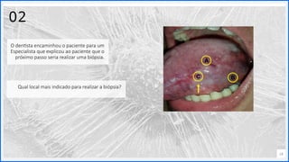 Contoso
P a c o t e s
Opção 2 de Divisor
de Seção
Lorem ipsum dolor sit ame
adipiscing elit
14
02
O dentista encaminhou o paciente para um
Especialista que explicou ao paciente que o
próximo passo seria realizar uma biópsia.
Qual local mais indicado para realizar a biópsia?
 