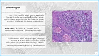 Contoso
P a c o t e s
Opção 2 de Divisor
de Seção
Lorem ipsum dolor sit ame
adipiscing elit
Laudo histopatológico indicou uma acentuada
hiperplasia basilar, desorganização celular e atipia,
hipercromia nuclear e aumento do número de figuras
mitóticas envolvendo o terço inferior do epitélio.
15
Conclusão: Carcinoma de células escamosas,
carcinoma espinocelular, carcinoma epidermoide.
Histopatológico
Com o diagnóstico final histopatológico, o cirurgião
agendou a paciente, em conjunto com equipe
multiprofissional, para tratamento integral da lesão.
O tratamento incluiu ressecção cirúrgica e radioterapia.
 