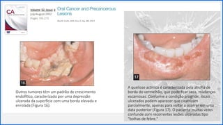 Contoso
P a c o t e s
Sobre nós
Lorem ipsum dolor sit amet,
consectetur adipiscing elit. Etiam
aliquet eu mi quis lacinia.
35
Outros tumores têm um padrão de crescimento
endofítico, caracterizado por uma depressão
ulcerada da superfície com uma borda elevada e
enrolada (Figura 16).
A queilose actínica é caracterizada pela atrofia de
borda do vermelhão, que pode ficar seca, mudanças
escamosas. Conforme a condição progride, locais
ulcerados podem aparecer que cicatrizam
parcialmente, apenas para voltar a ocorrer em uma
data posterior (Figura 17). O paciente muitas vezes
confunde com recorrentes lesões ulceradas tipo
"bolhas de febre."
 