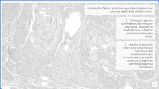 Contoso
P a c o t e s
37
2. regiões da boca são
coberta por uma mucosa
mais fina e não
queratinizada, que
fornece menos proteção
contra carcinogênicos
(permeabilidade da
membrana)
Existem dois fatores principais que podem explicar por
que essa região é de altíssimo risco:
1. Quaisquer agentes
cancerígenos irão misturar
com saliva, (piscina) no
fundo da boca, e banhar
constantemente esses
locais.
 
