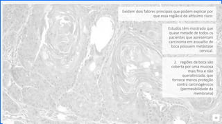 Contoso
P a c o t e s
38
2. regiões da boca são
coberta por uma mucosa
mais fina e não
queratinizada, que
fornece menos proteção
contra carcinogênicos
(permeabilidade da
membrana)
Existem dois fatores principais que podem explicar por
que essa região é de altíssimo risco:
Estudos têm mostrado que
quase metade de todos os
pacientes que apresentam
carcinoma em assoalho de
boca possuem metástase
cervical.
 