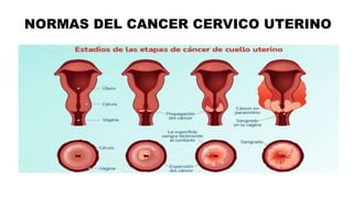 NORMAS DEL CANCER CERVICO UTERINO
 