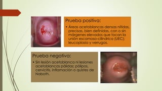 Prueba positiva:
• Áreas acetoblancas densas nítidas,
precisas, bien definidas, con o sin
márgenes elevados que tocan la
unión escamoso-cilíndrica (UEC);
leucoplasia y verrugas.
Prueba negativa:
• Sin lesión acetoblanca ni lesiones
acetoblancas pálidas; pólipos,
cervicitis, inflamación o quistes de
Naboth.
 