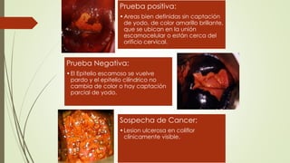 Prueba positiva:
•Areas bien definidas sin captación
de yodo, de color amarillo brillante,
que se ubican en la unión
escamocelular o están cerca del
orificio cervical.
Prueba Negativa:
•El Epitelio escamoso se vuelve
pardo y el epitelio cilíndrico no
cambia de color o hay captación
parcial de yodo.
Sospecha de Cancer:
•Lesion ulcerosa en coliflor
clínicamente visible.
 